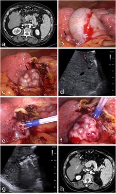 Laparoscopic electrochemotherapy for the treatment of hepatocellular carcinoma: Technological advancement